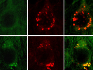 It's not amyloid beta that causes Alzheimer's disease, Nature confirms!